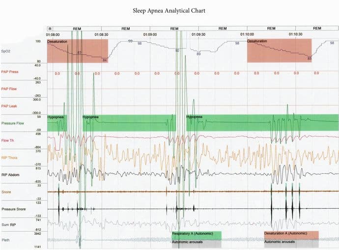 Treatment of sleeplessness. Sleep Apnea monitored overnight with a polysomnogram (PSG)