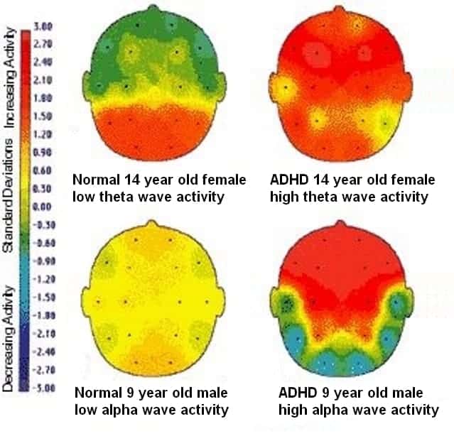 Brain development and function in ADHD